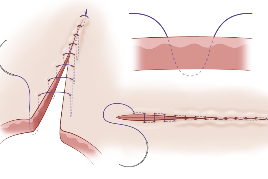 Connell suture shop