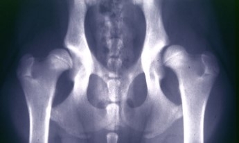 X-ray of dysplastic hips in a lab. 